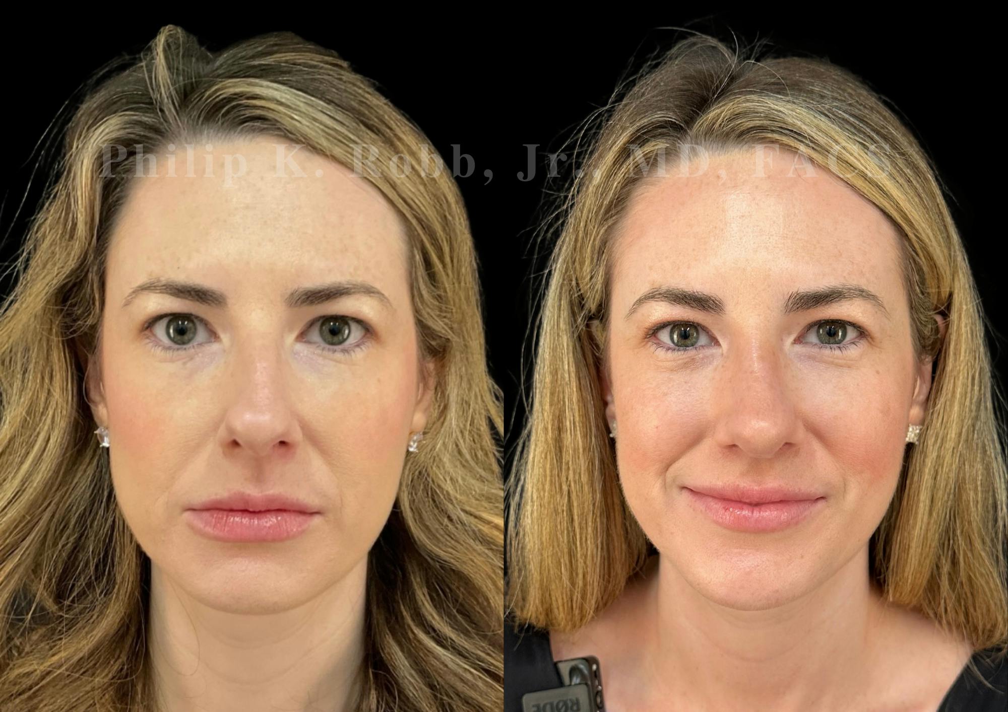 Ultrasonic Rhinoplasty Before & After Gallery - Patient 151963 - Image 3