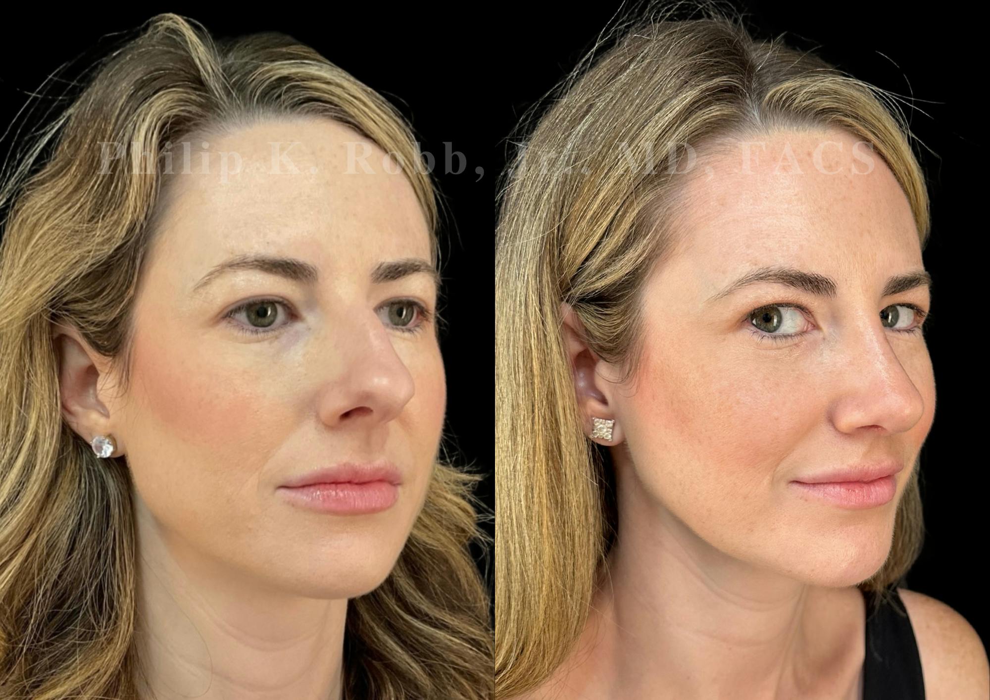 Ultrasonic Rhinoplasty Before & After Gallery - Patient 151963 - Image 2