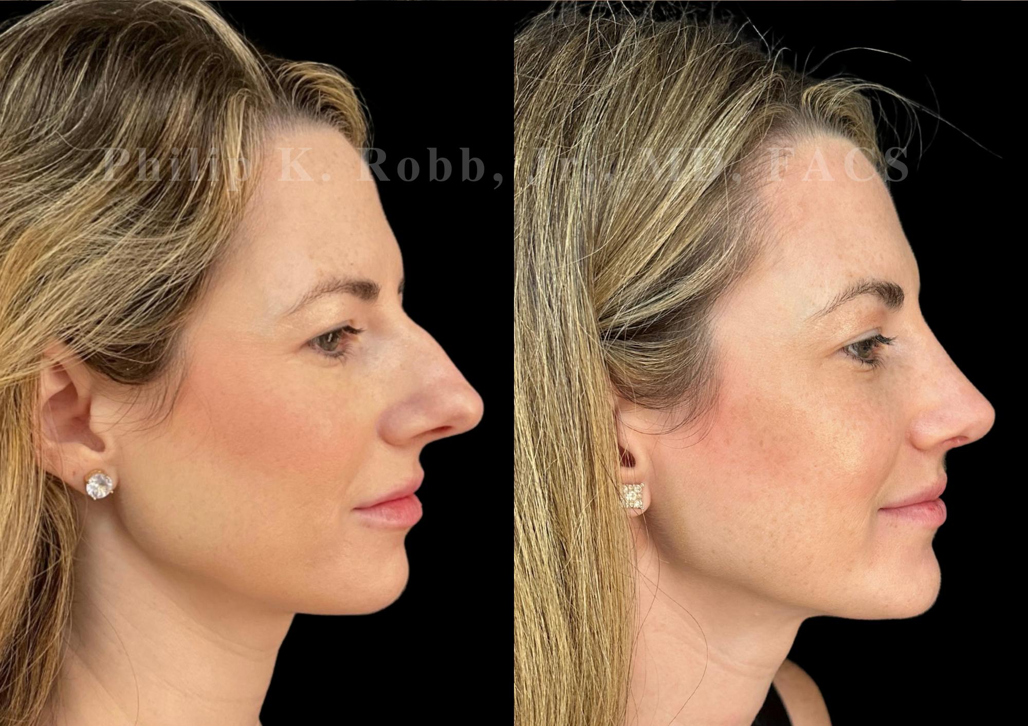 Ultrasonic Rhinoplasty Before & After Gallery - Patient 151963 - Image 1