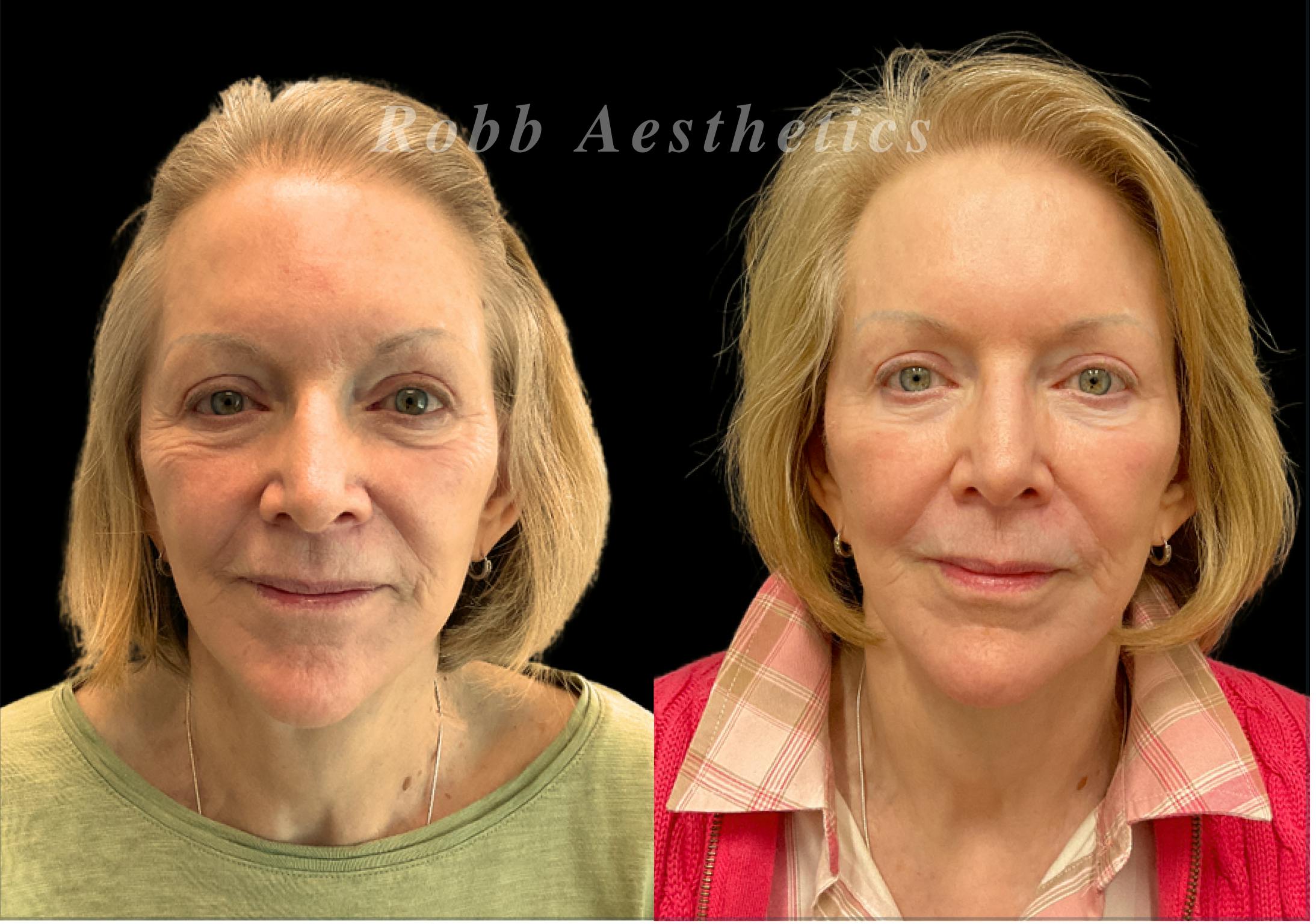 Skin Resurfacing Before & After Gallery - Patient 120904 - Image 1