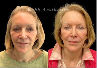 Skin Resurfacing Before & After Gallery - Patient 120904 - Image 1
