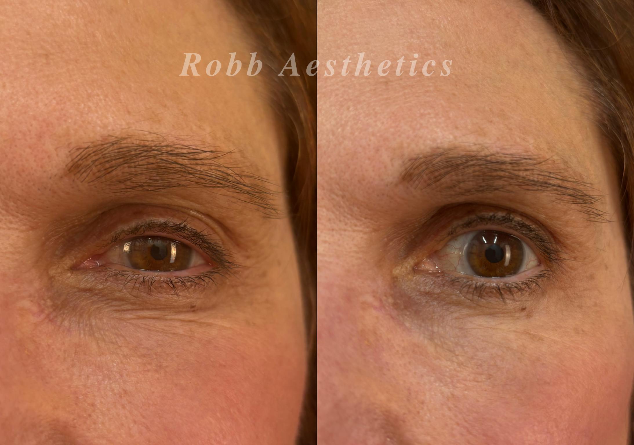 Upneeq Before & After Gallery - Patient 183353 - Image 1