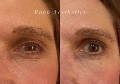 Upneeq Before & After Gallery - Patient 183353 - Image 1