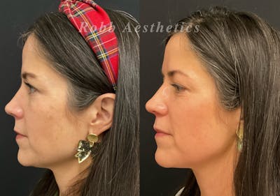 Skin Resurfacing Before & After Gallery - Patient 311053 - Image 1