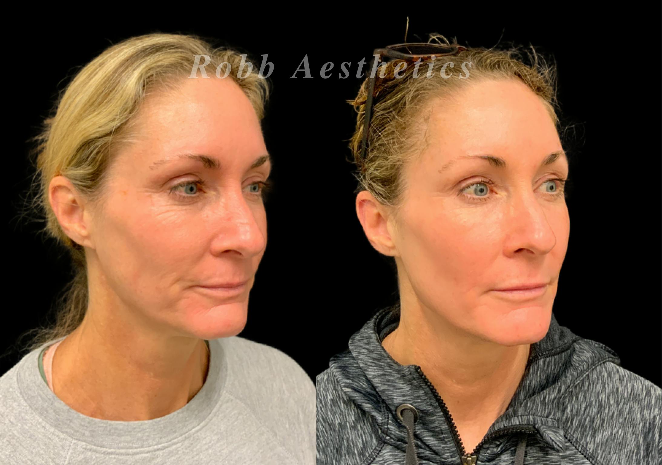 Botox & Dysport Before & After Gallery - Patient 164481 - Image 1