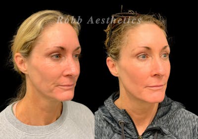 Botox & Dysport Before & After Gallery - Patient 164481 - Image 1
