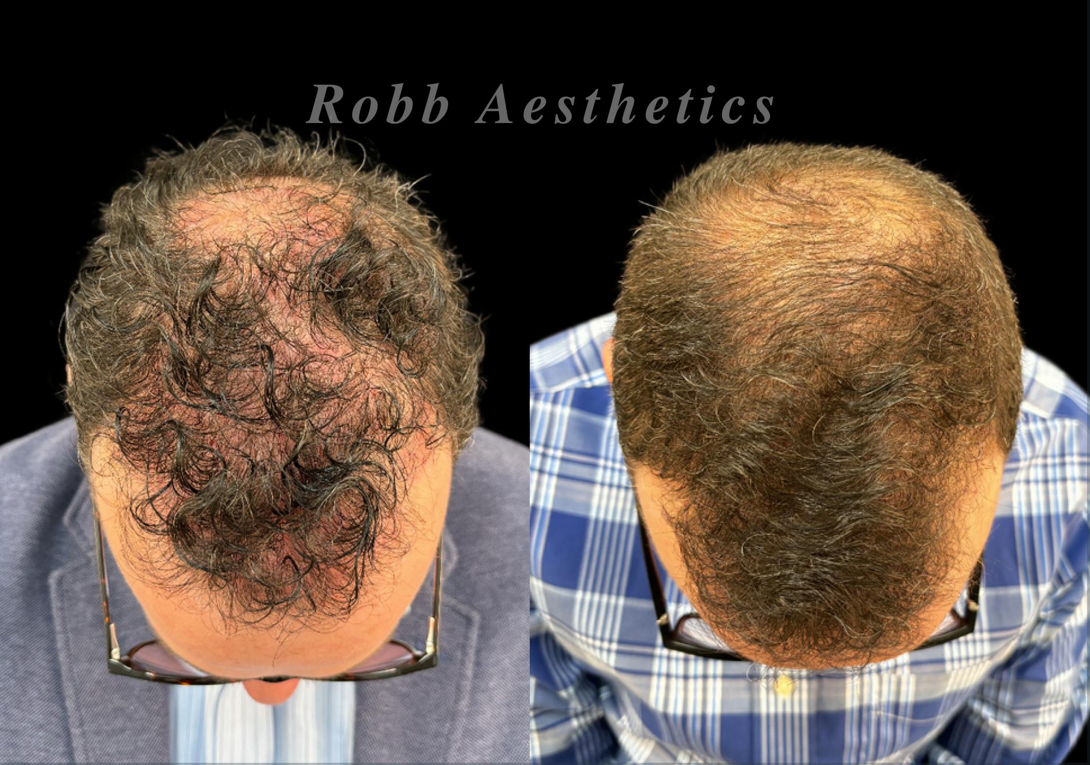 Hair Exosome Injection Before & After Gallery - Patient 336651 - Image 1