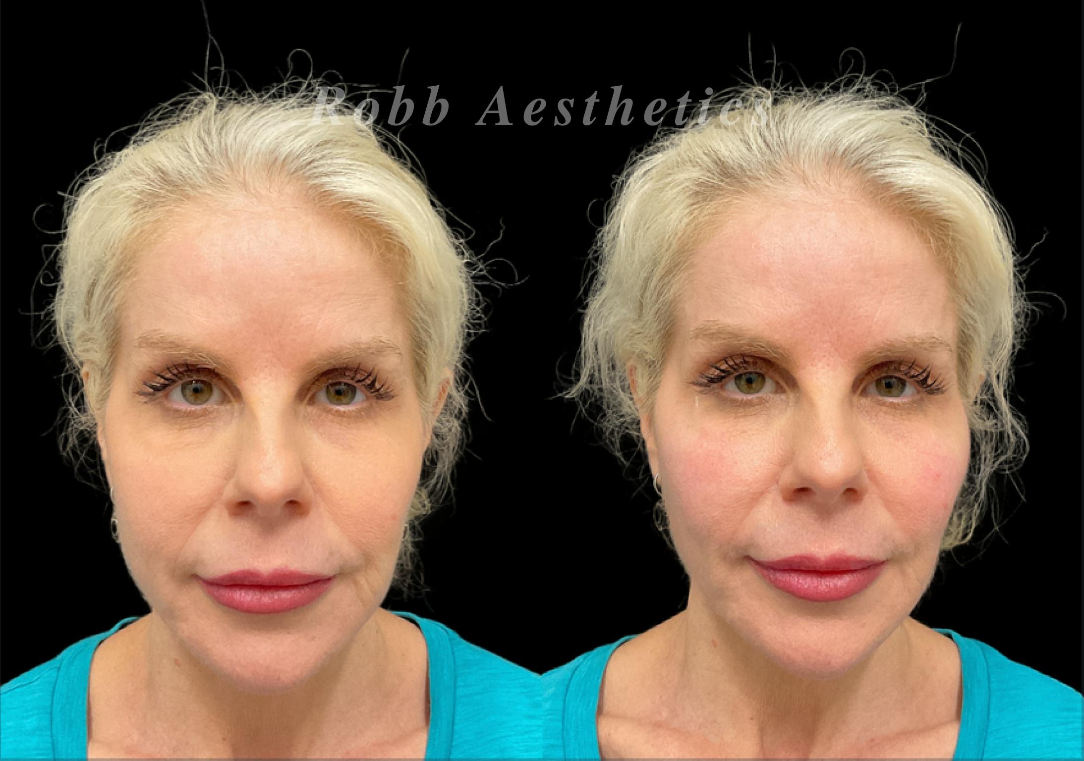 Fillers Before & After Gallery - Patient 876859 - Image 1