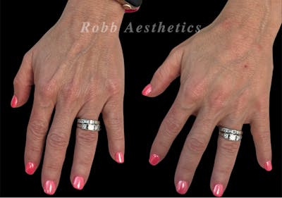 Fillers Before & After Gallery - Patient 322474 - Image 1