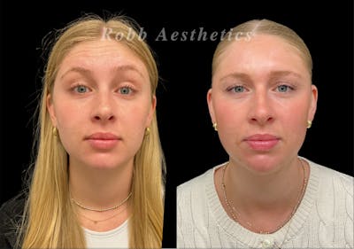 Botox & Dysport Before & After Gallery - Patient 227190 - Image 1