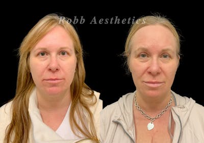 Skin Resurfacing Before & After Gallery - Patient 300804 - Image 1