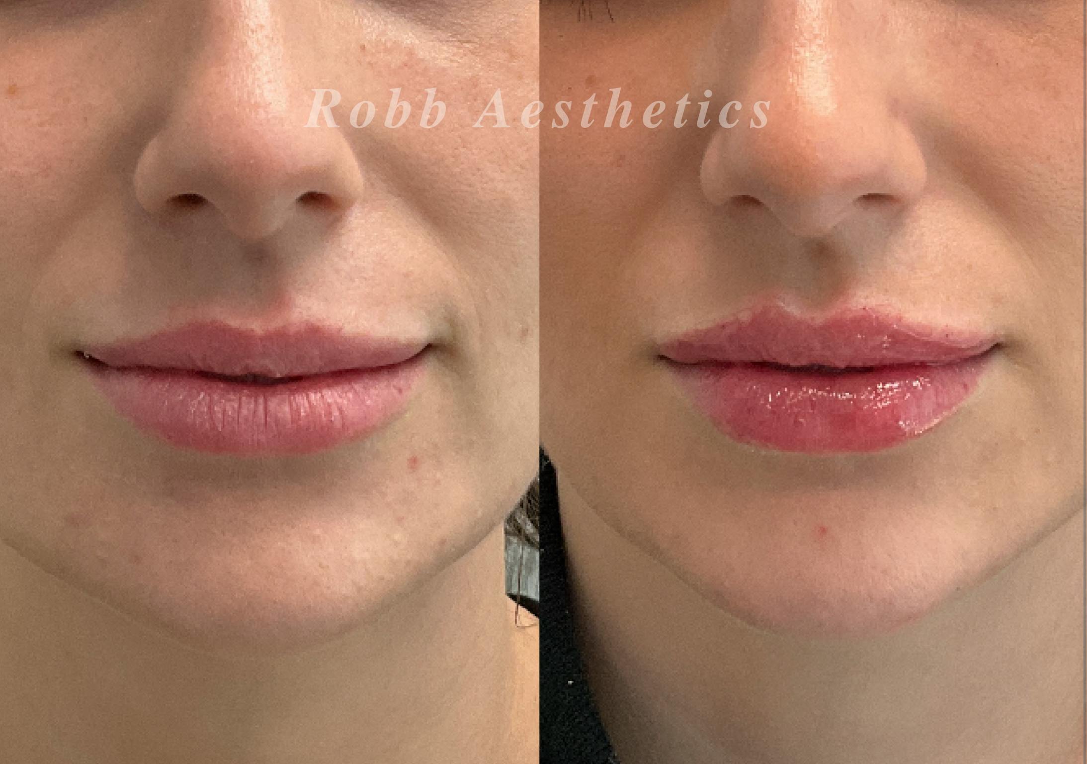 Fillers Before & After Gallery - Patient 193457 - Image 1