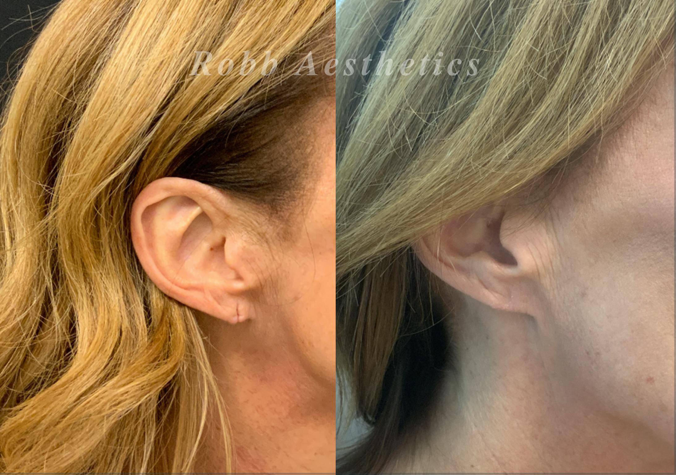 Ear Lobe Repair Before & After Gallery - Patient 378367 - Image 1