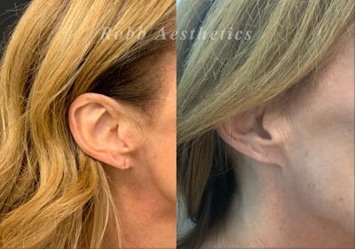 Ear Lobe Repair Before & After Gallery - Patient 378367 - Image 1