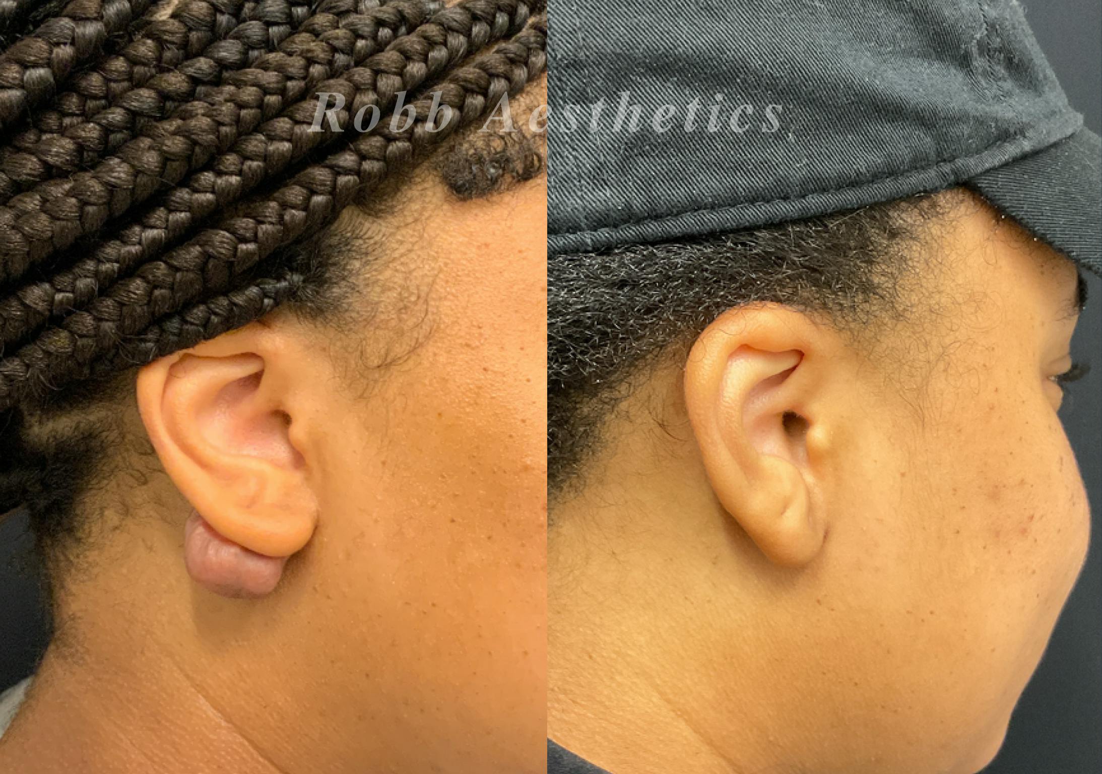 Scar Revision Before & After Gallery - Patient 274093 - Image 1