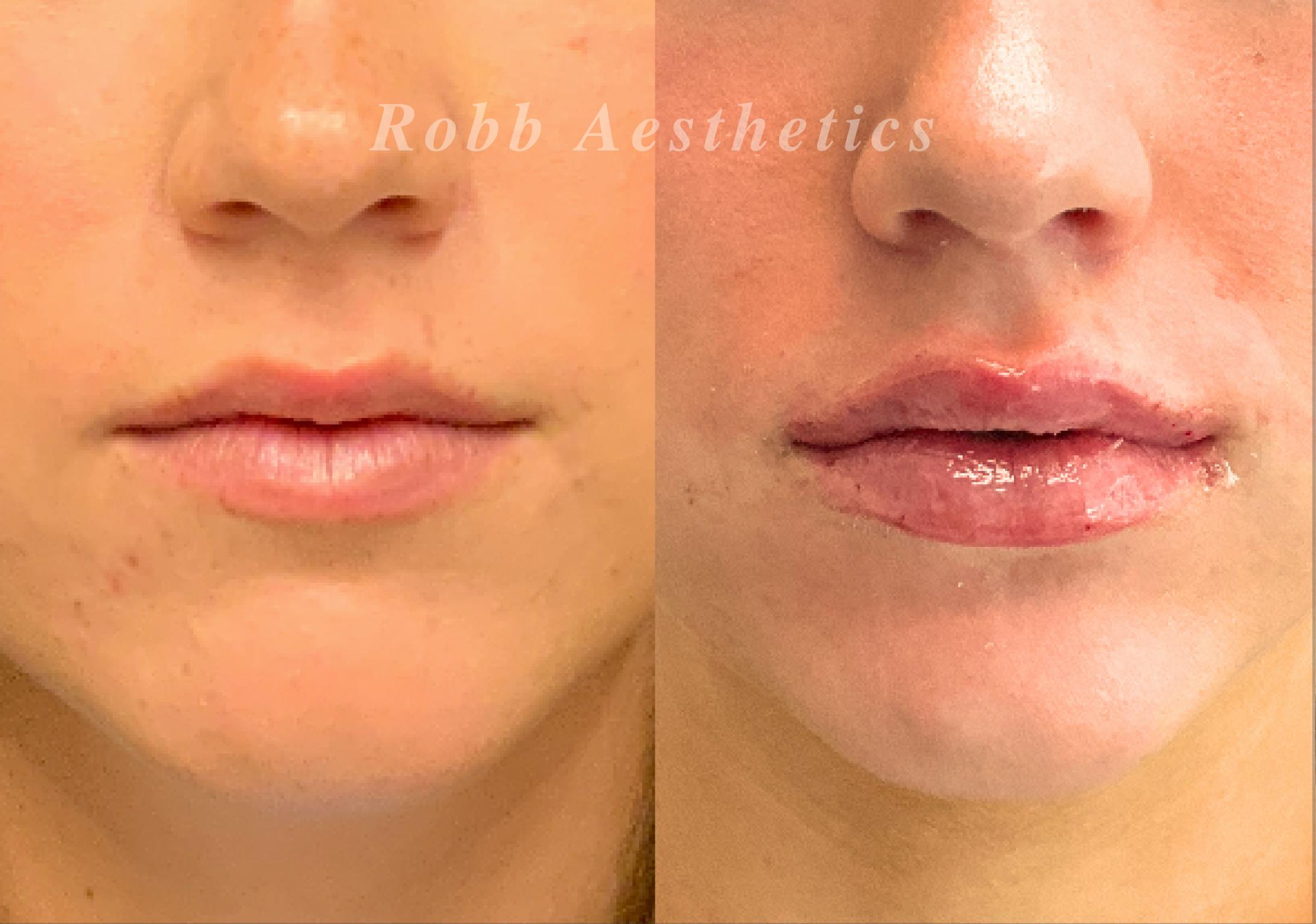 Fillers Before & After Gallery - Patient 330059 - Image 1