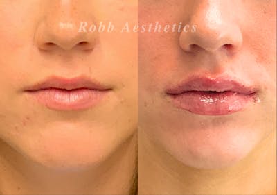 Fillers Before & After Gallery - Patient 330059 - Image 1