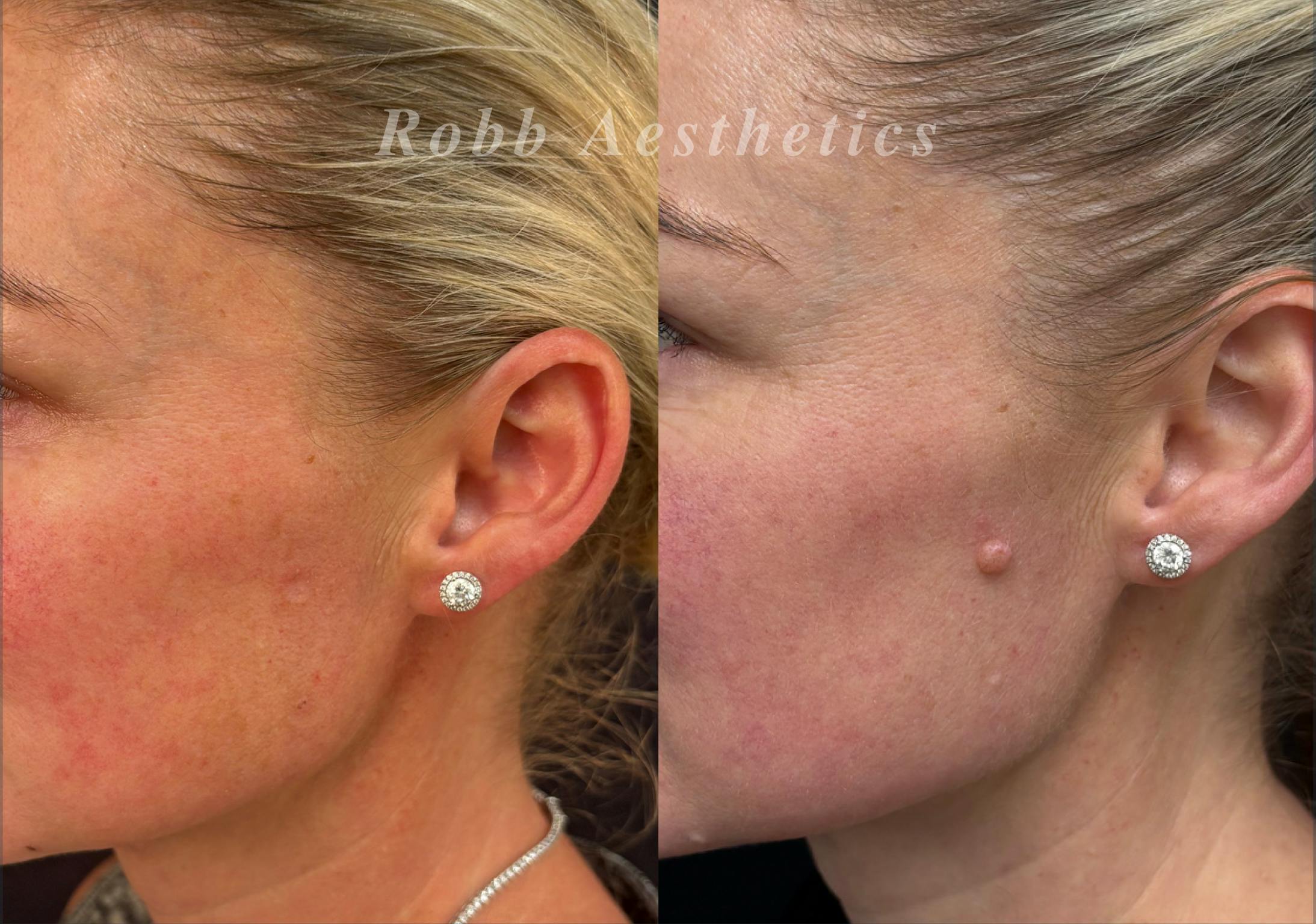 Mole Vaporization Before & After Gallery - Patient 401708 - Image 1