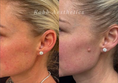 Mole Vaporization Before & After Gallery - Patient 401708 - Image 1