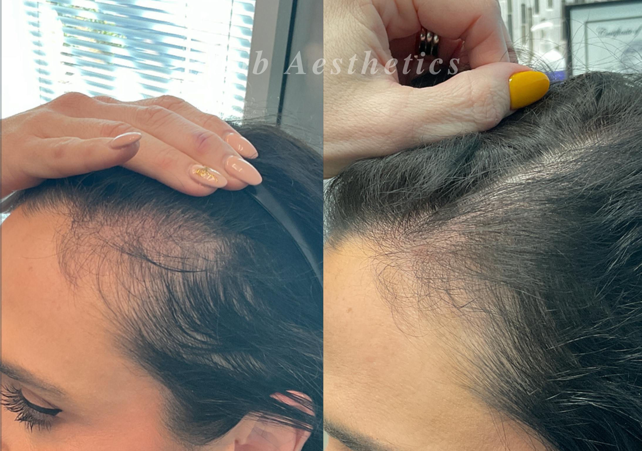 Hair Exosome Injection Before & After Gallery - Patient 427047 - Image 1
