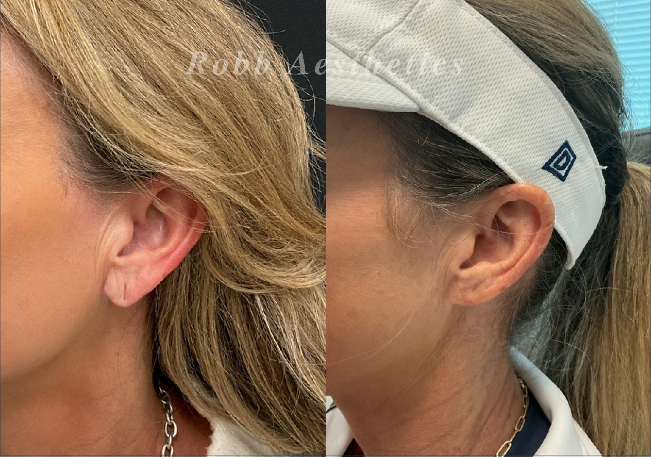 Ear Lobe Repair Before & After Gallery - Patient 283323 - Image 1