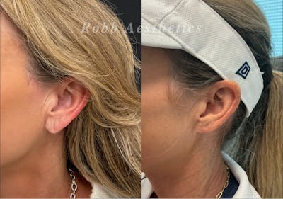 Ear Lobe Repair Before & After Gallery - Patient 283323 - Image 1