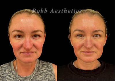 Skin Resurfacing Before & After Gallery - Patient 282090 - Image 1