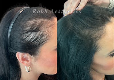 Hair Exosome Injection Before & After Gallery - Patient 403451 - Image 1