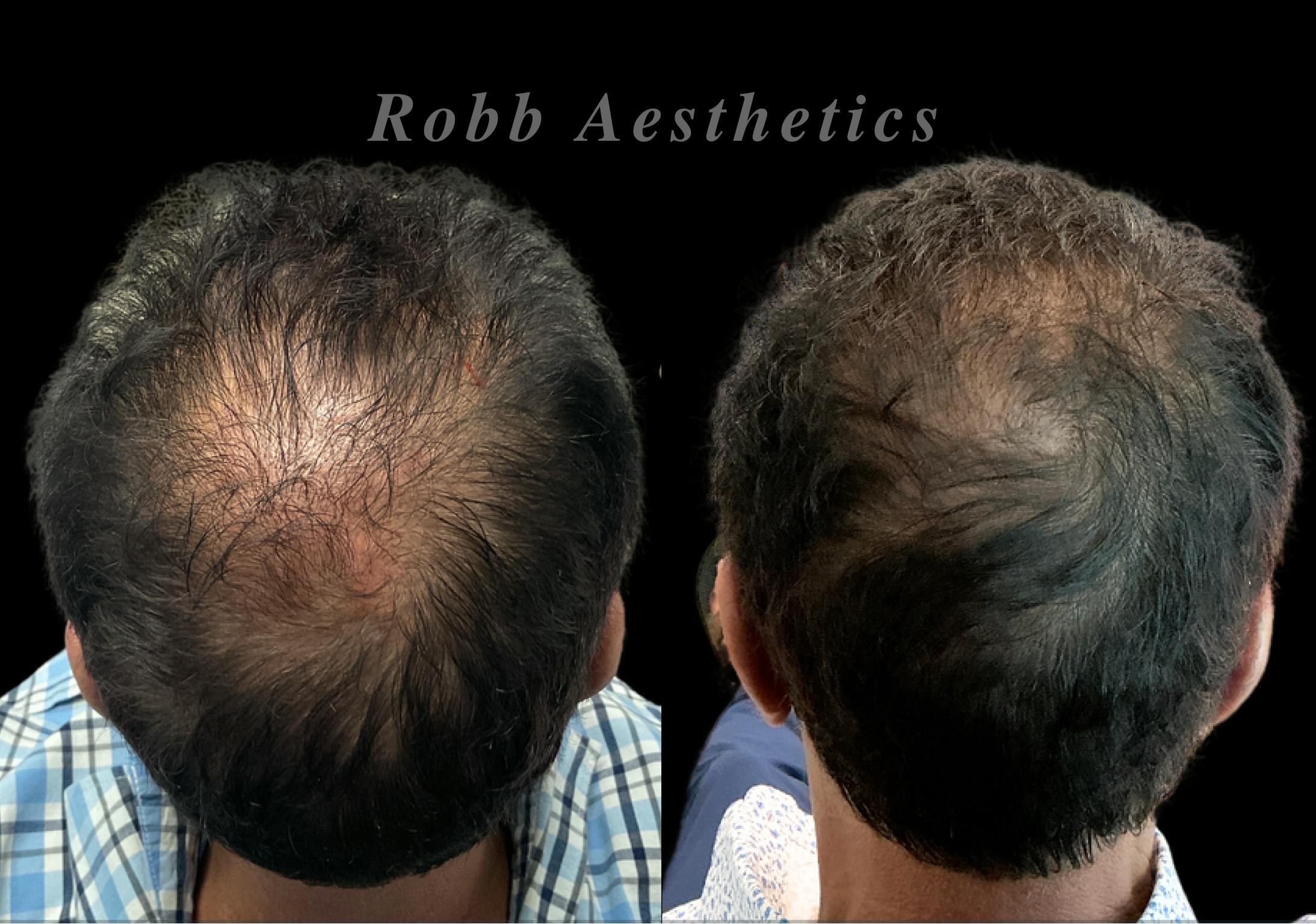 Hair Exosome Injection Before & After Gallery - Patient 180622 - Image 1