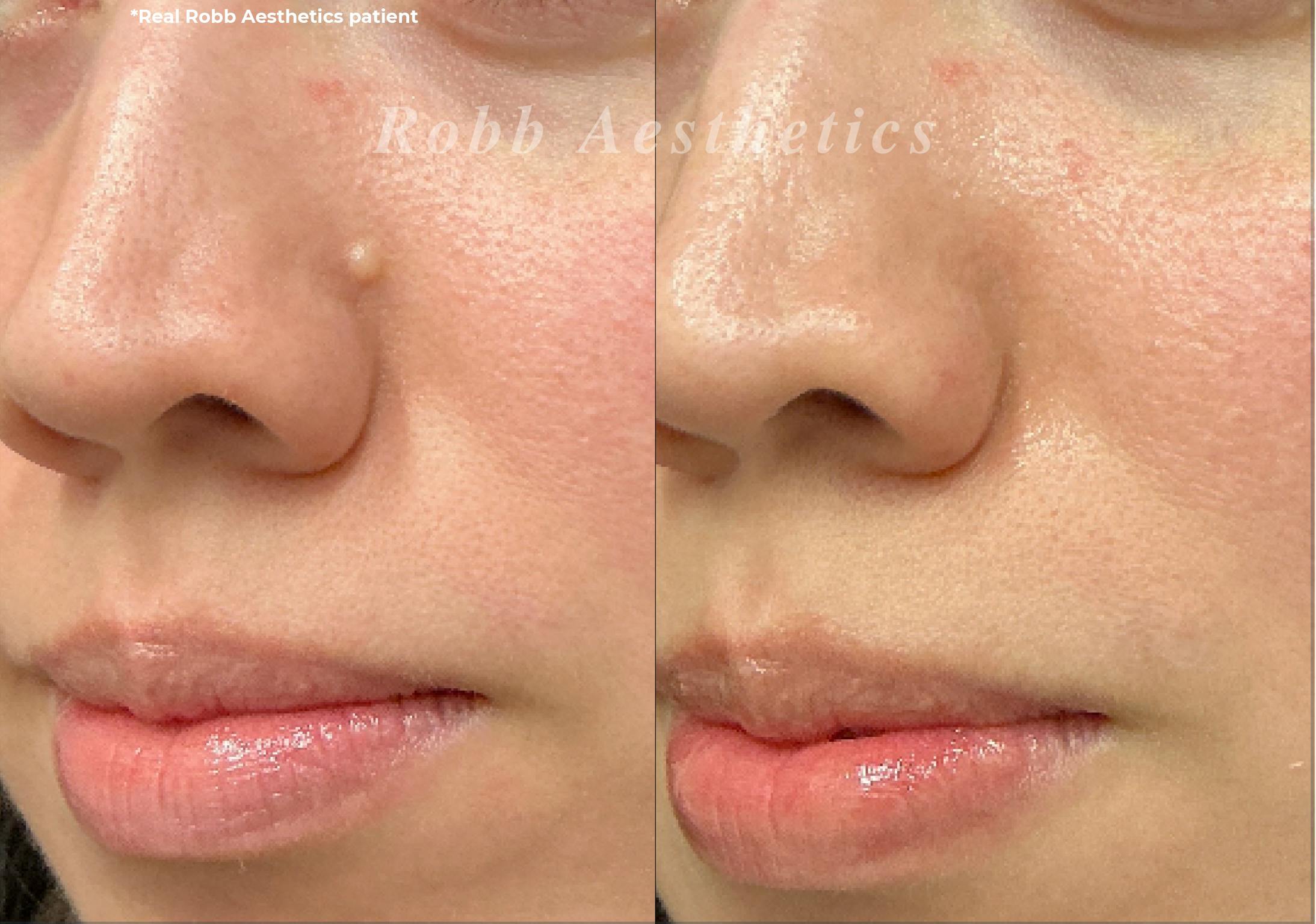 Mole Vaporization Before & After Gallery - Patient 333143 - Image 1