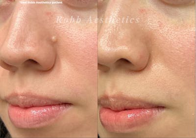 Mole Vaporization Before & After Gallery - Patient 333143 - Image 1