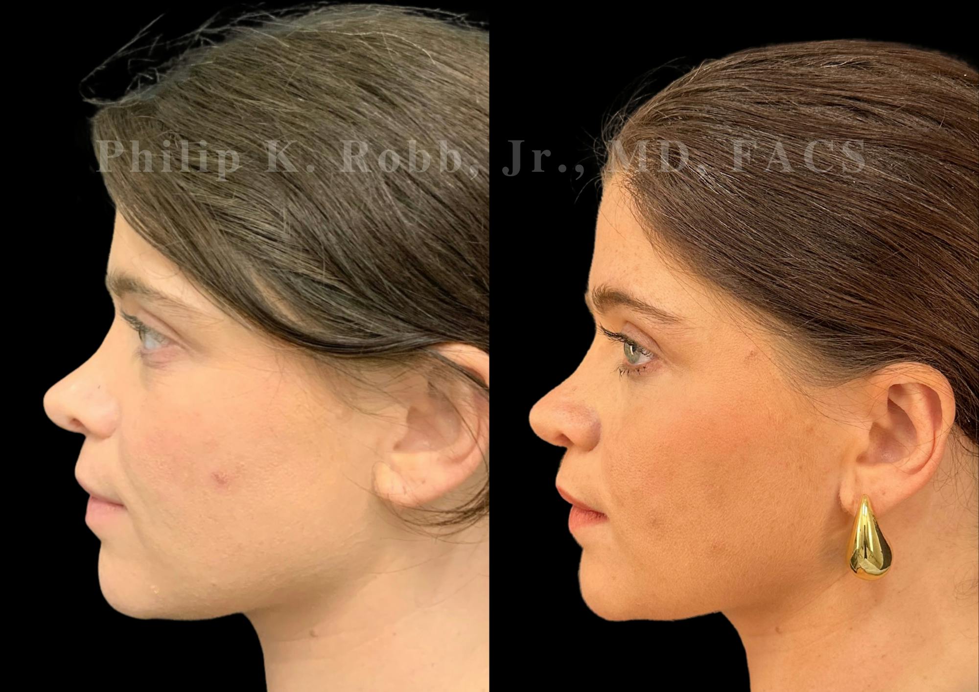 Ultrasonic Rhinoplasty Before & After Gallery - Patient 117716 - Image 5