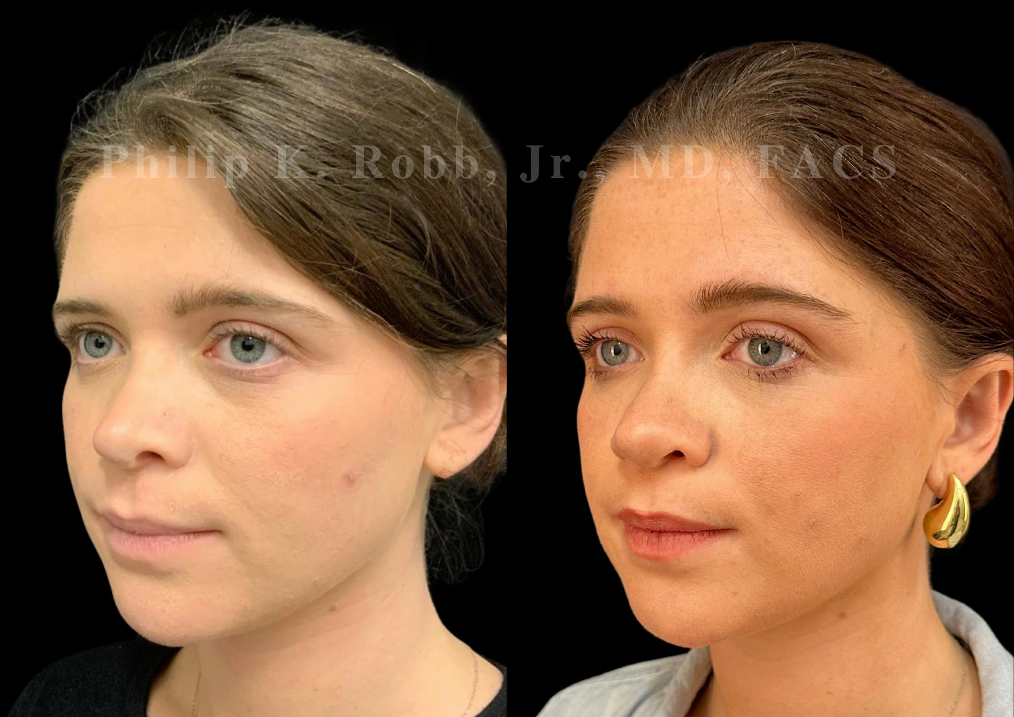 Ultrasonic Rhinoplasty Before & After Gallery - Patient 117716 - Image 4