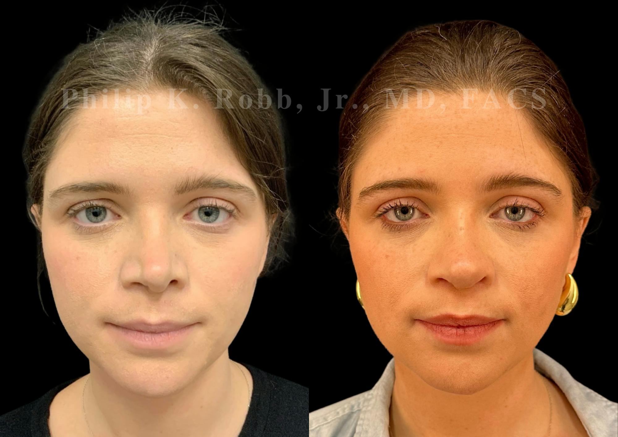 Ultrasonic Rhinoplasty Before & After Gallery - Patient 117716 - Image 3