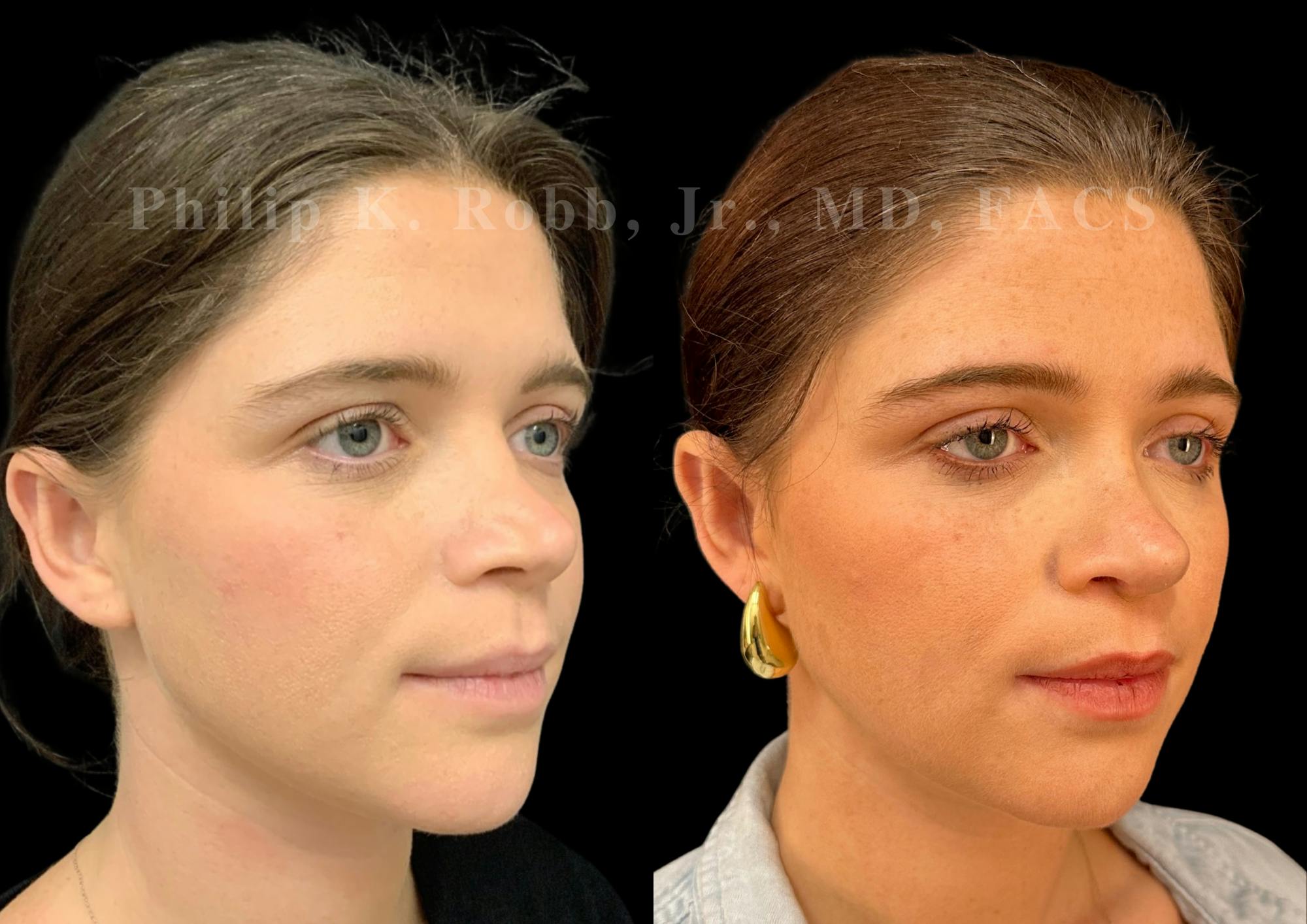 Ultrasonic Rhinoplasty Before & After Gallery - Patient 117716 - Image 2