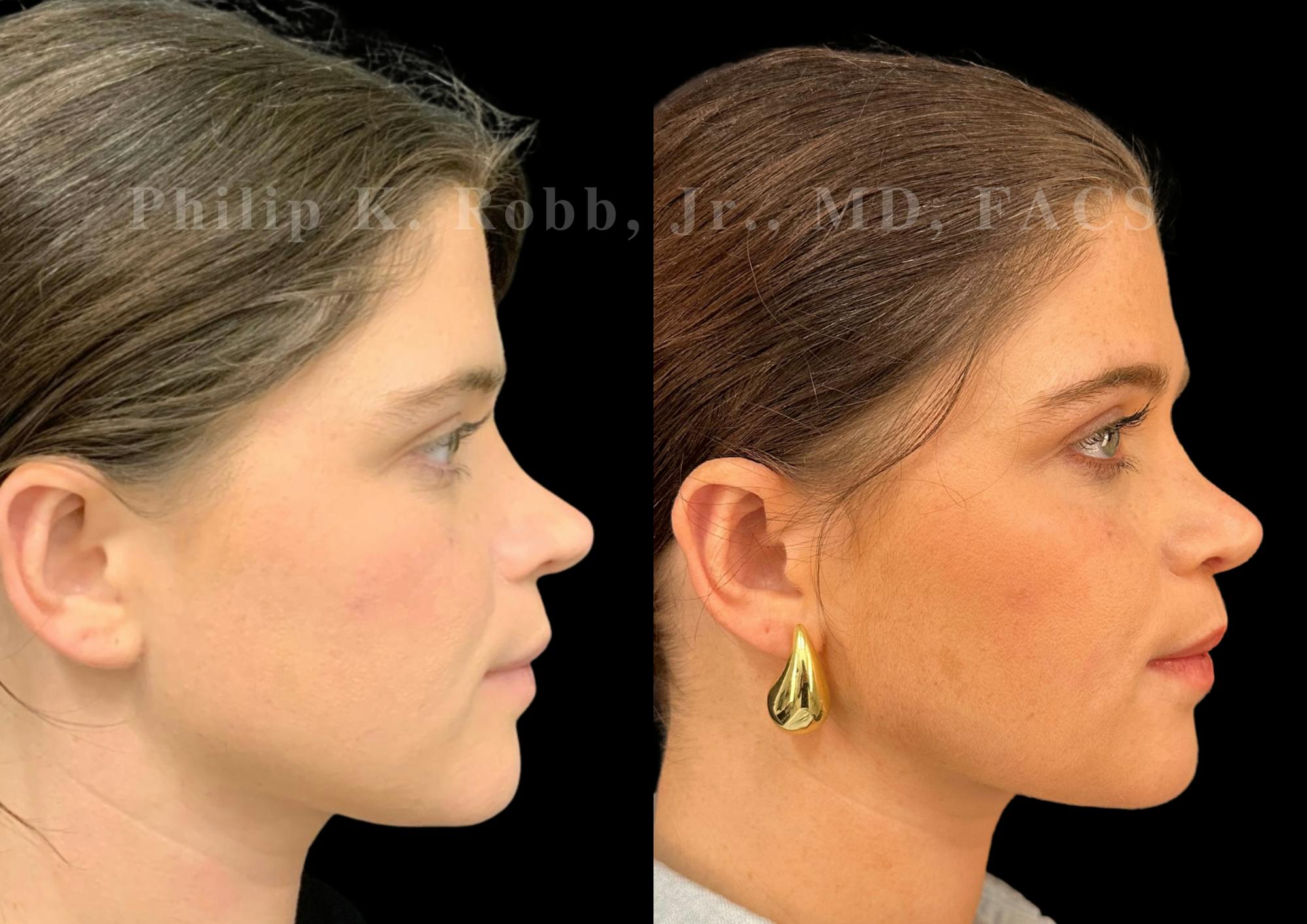 Ultrasonic Rhinoplasty Before & After Gallery - Patient 117716 - Image 1