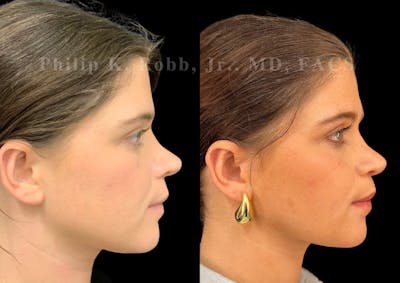 Revision Ultrasonic Rhinoplasty Before & After Gallery - Patient 283352 - Image 1
