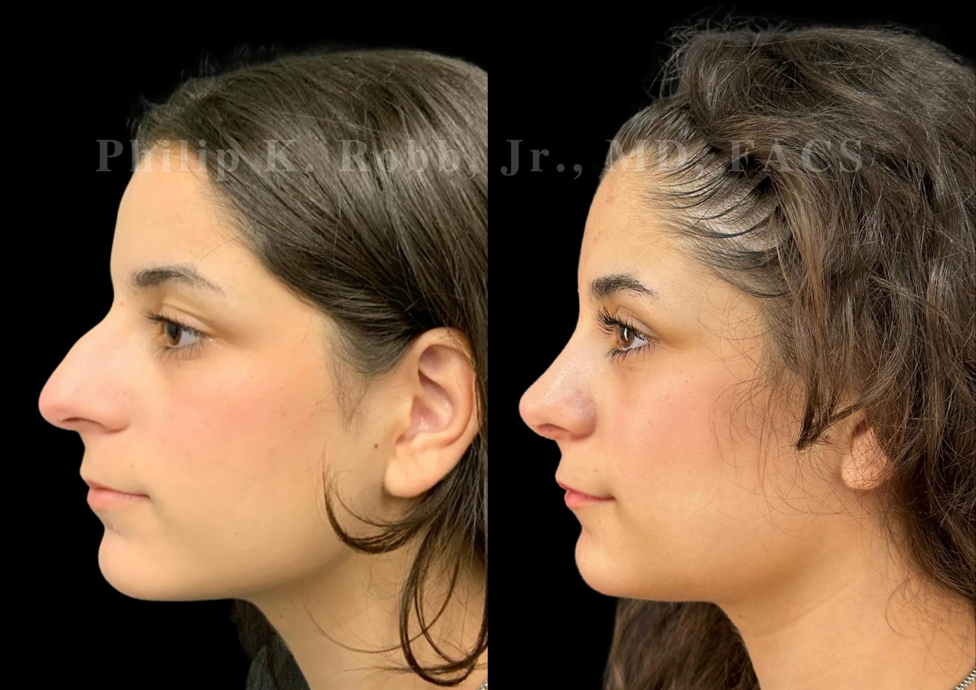 Ultrasonic Rhinoplasty Before & After Gallery - Patient 195622 - Image 5