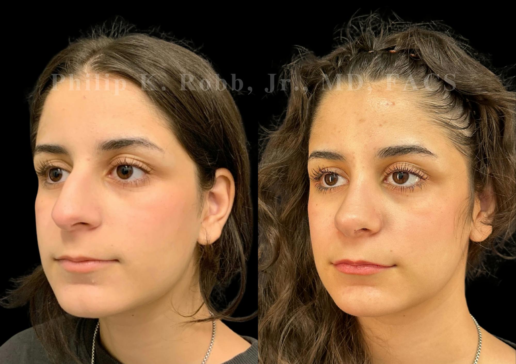 Ultrasonic Rhinoplasty Before & After Gallery - Patient 195622 - Image 4