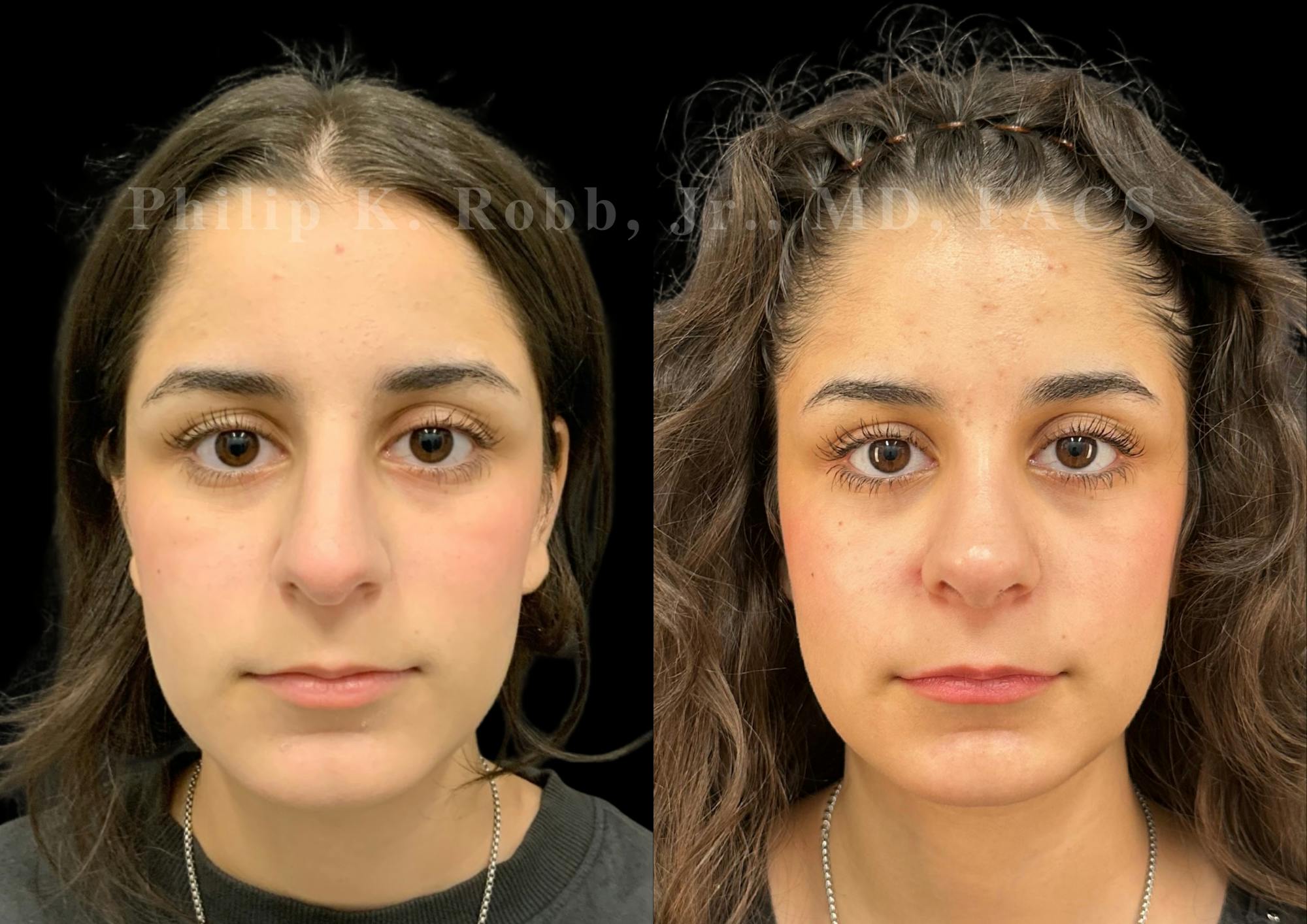 Ultrasonic Rhinoplasty Before & After Gallery - Patient 195622 - Image 3