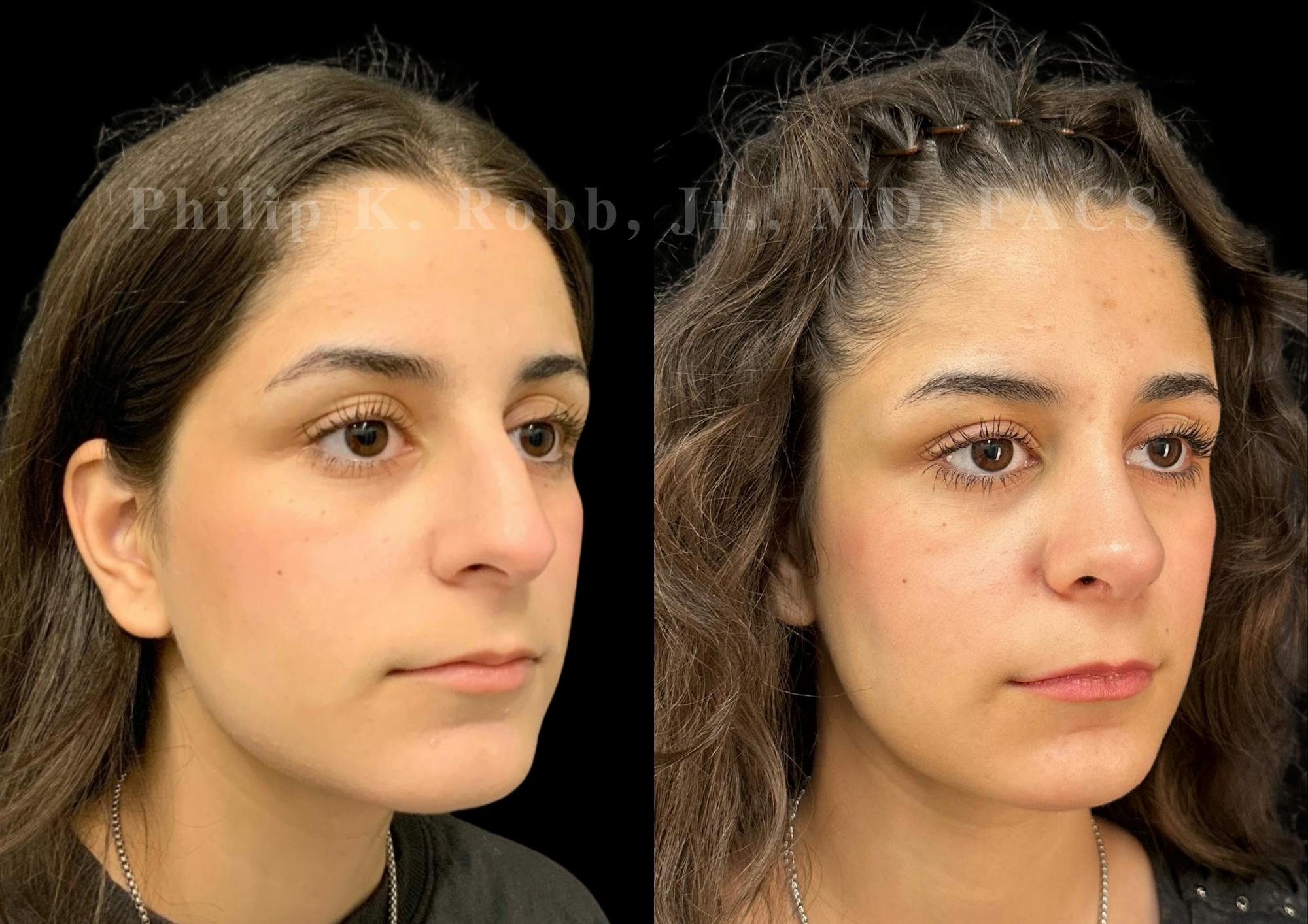 Ultrasonic Rhinoplasty Before & After Gallery - Patient 195622 - Image 2