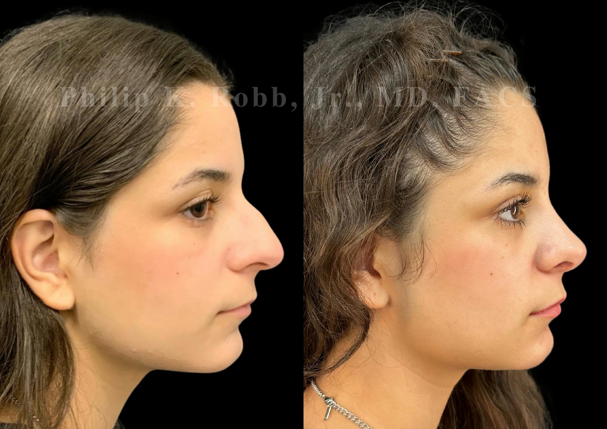 Ultrasonic Rhinoplasty Before & After Gallery - Patient 195622 - Image 1