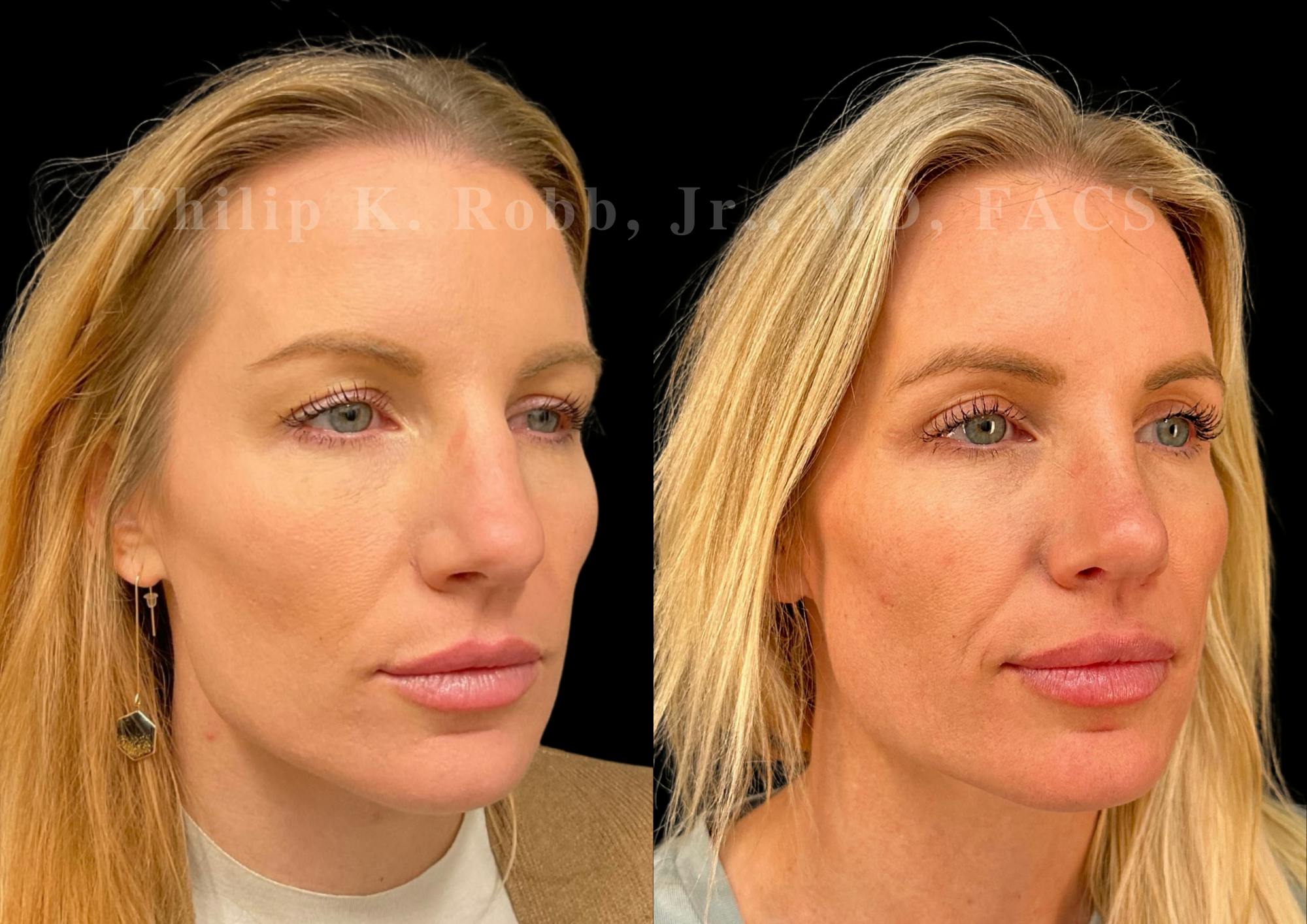 Upper Blepharoplasty Before & After Gallery - Patient 201974 - Image 4