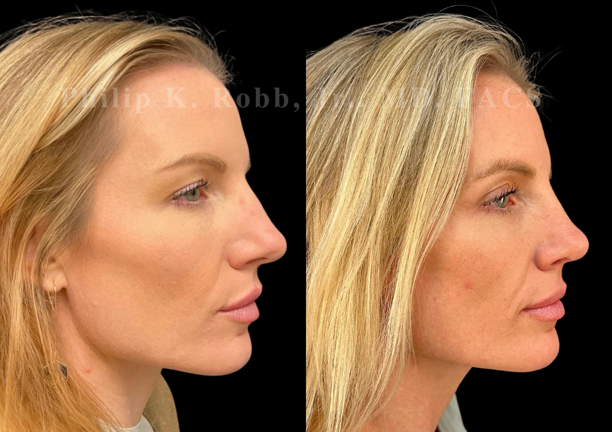 Upper Blepharoplasty Before & After Gallery - Patient 201974 - Image 5