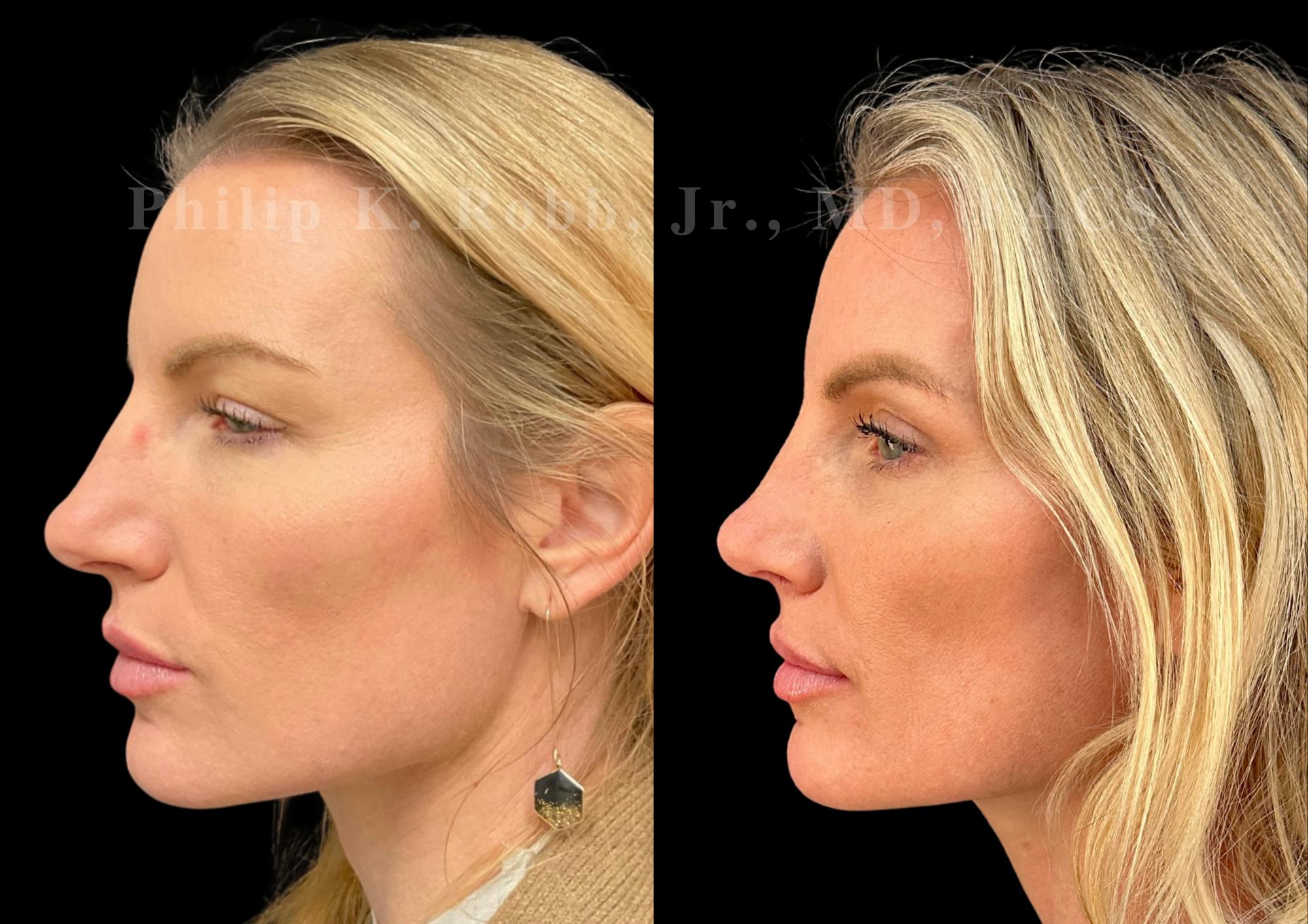 Upper Blepharoplasty Before & After Gallery - Patient 201974 - Image 2