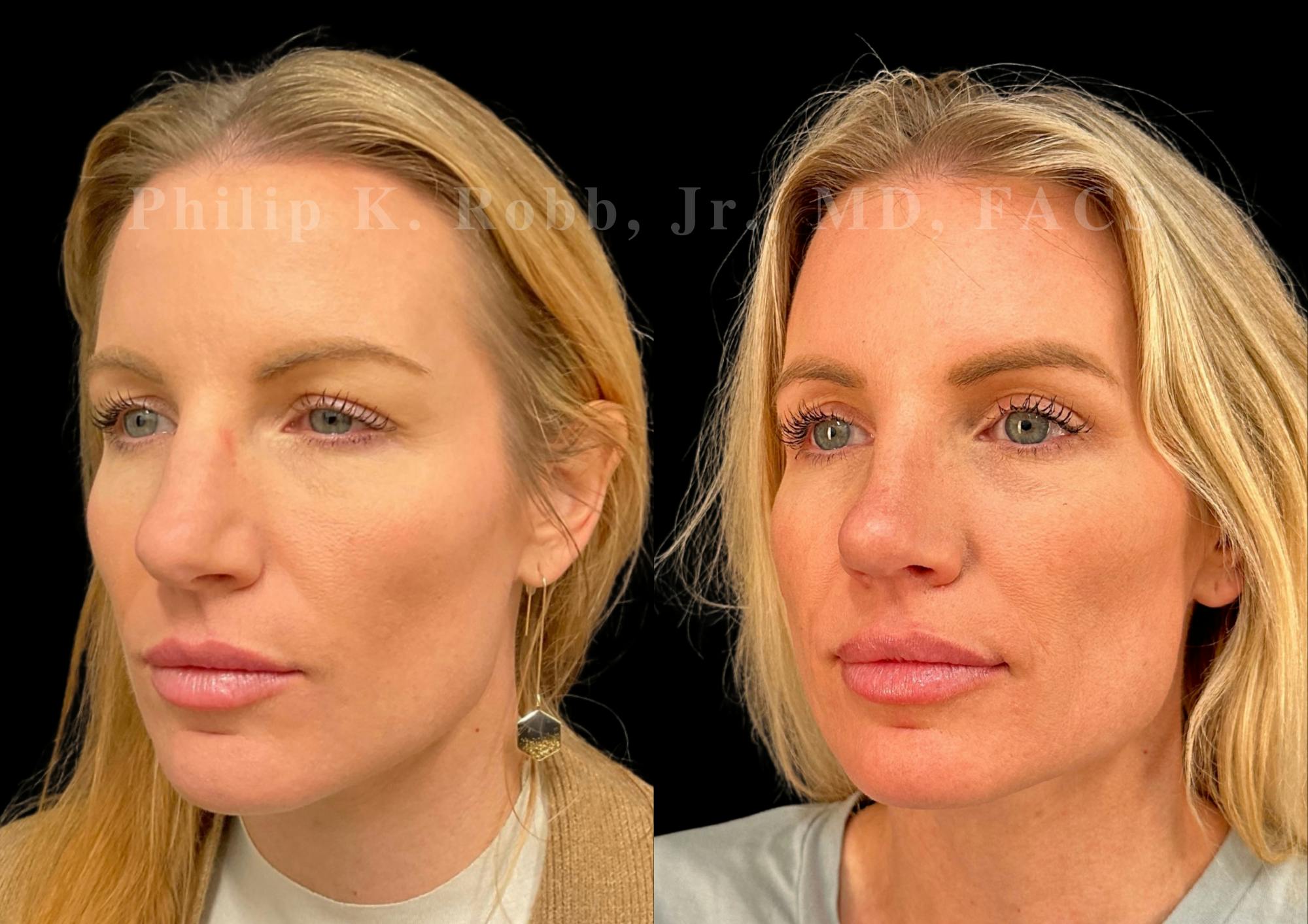 Upper Blepharoplasty Before & After Gallery - Patient 201974 - Image 3