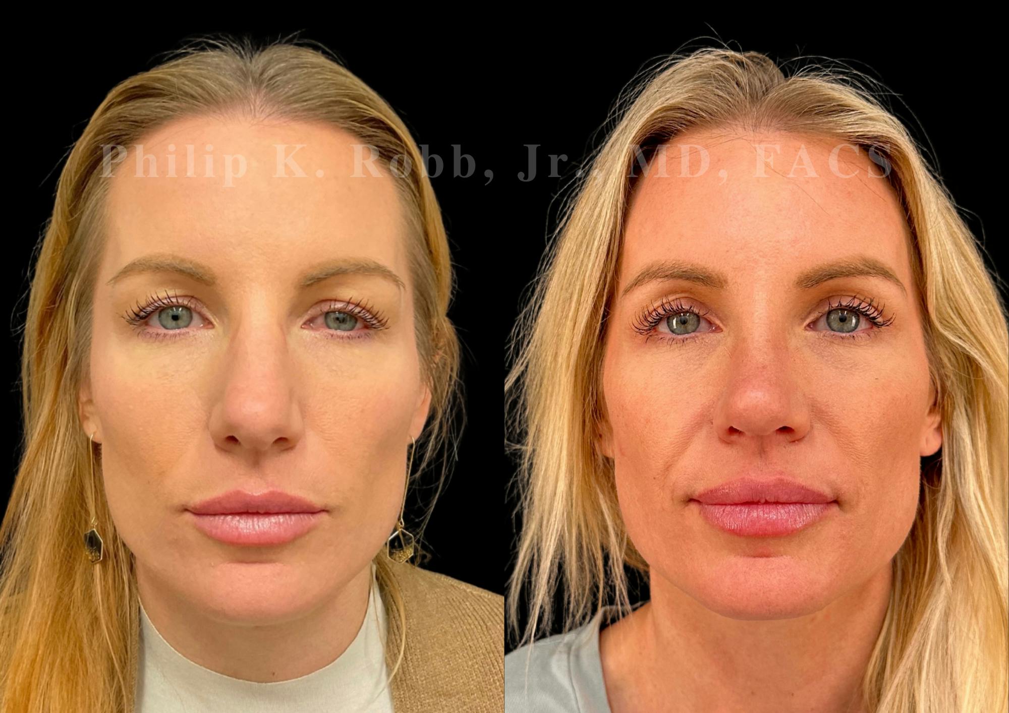 Upper Blepharoplasty Before & After Gallery - Patient 201974 - Image 1
