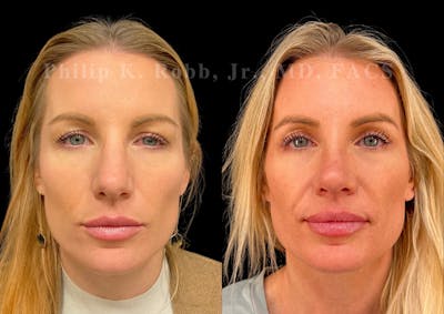 Laser Skin Resurfacing Before & After Gallery - Patient 292549 - Image 1