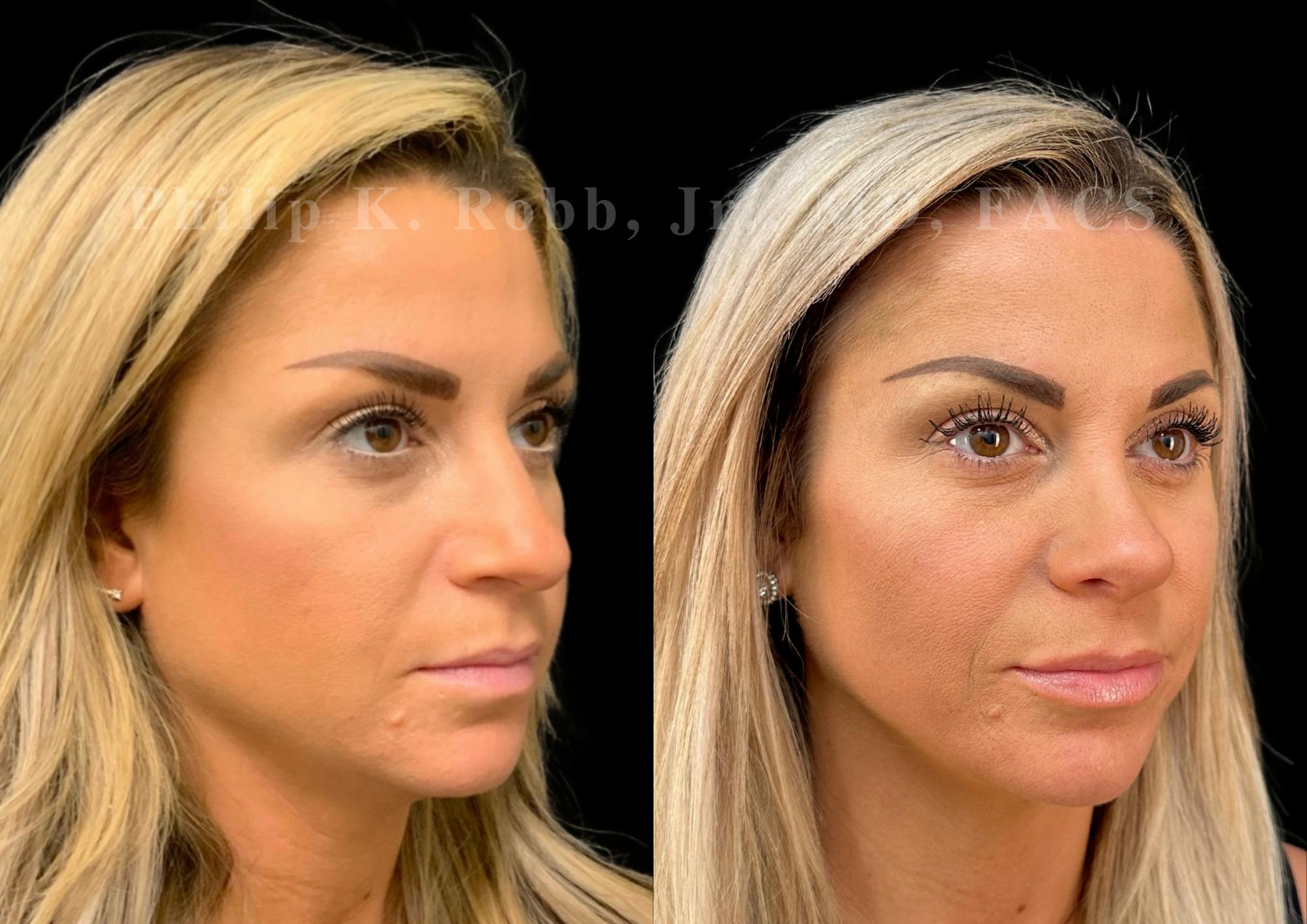 Ultrasonic Rhinoplasty Before & After Gallery - Patient 129608 - Image 2