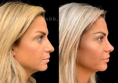 Ultrasonic Rhinoplasty Before & After Gallery - Patient 129608 - Image 1